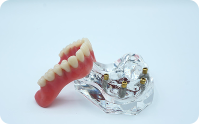 Implant-retained dentures on a model
