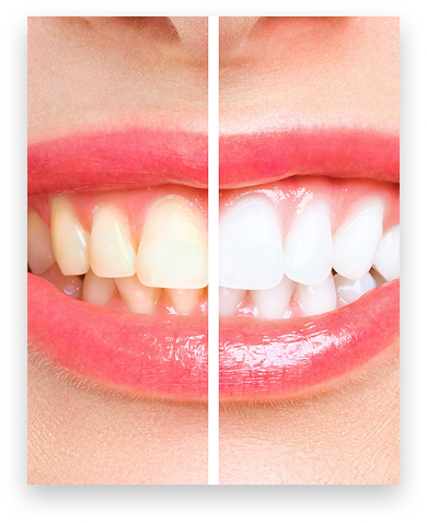Teeth whitening before and after